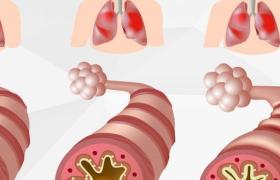 How To Survive An Asthma Attach Without an Inhaler
